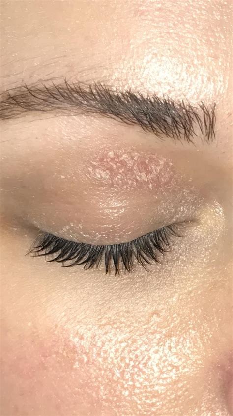 Skin Concern What Is This Patch On My Eyelid How Do I Treat It It S Dry And Stings