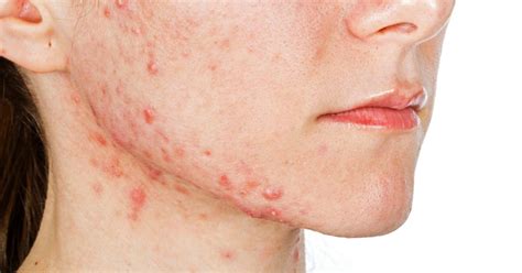 Jawline Acne Causes Treatment And Prevention