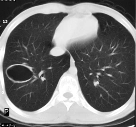 Pulmonary Cyst