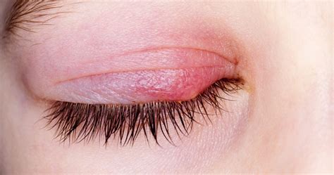 White Bumps On The Eyelid