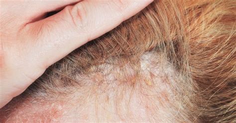 Check spelling or type a new query. Scalp psoriasis: Shampoos, home remedies, and causes