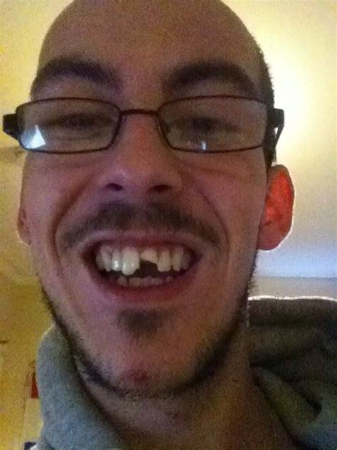 I Look Like An Extra From Jeremy Kyle Student Loses Front Tooth On A Night Out