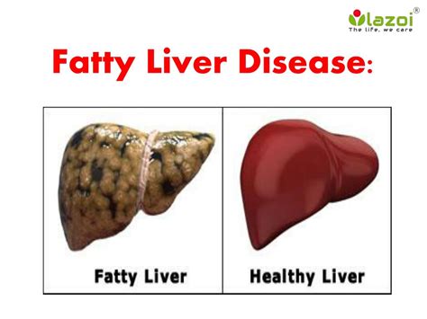 Ppt Fatty Liver Disease Information On Symptoms Causes And