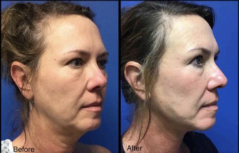 Woman With Face And Neck Lift Before And After Carolina Coastal