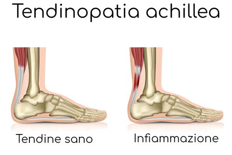 Tendine D Achille E Tendinite Dolore E Infiammazione