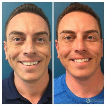 Before And After Male Facial Rejuvenation Arcadia Wellness Center