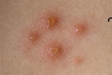 Adult Chicken Pox Symptoms Pictures 39 Photos And Images