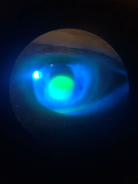 Corneal ulcer seen with fluress and blue light | Corneal ulcer, Corneal, Celestial
