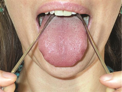 Simply hold the scraper at the back of your tongue, and bring it forward, scraping. Stainless Steel Tongue Scraper | Buy Tongue Cleaner | How ...