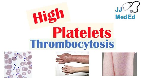 What Causes High Platelets Thrombocytosis Approach To Causes