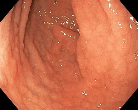 Upper Gastrointestinal Endoscopy Showing Nodularity In The Duodenal