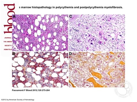 Bone Marrow Histopathology In Polycythemia And Postpolycythemia