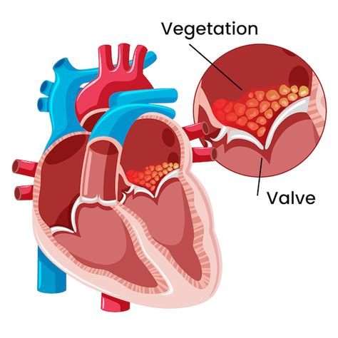 What Is Infective Endocarditis Resources For Safer Injection And