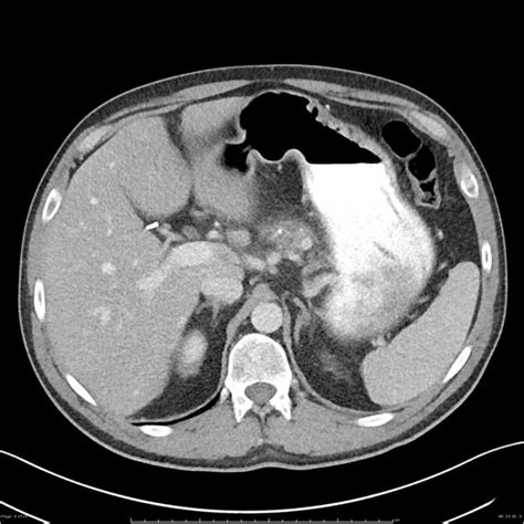 Chronic Pancreatits Radiology Case