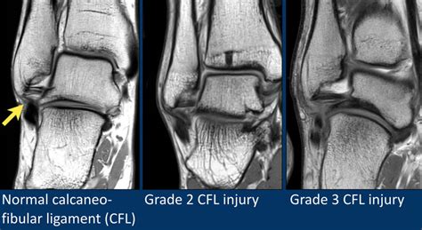 It is part of the lateral collateral ligament, which opposes the hyperinversion of the subtalar joint, as in a common type of ankle sprain. The Radiology Assistant : MRI examination of the ankle