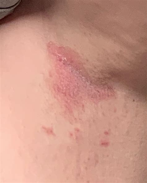 Help Please Armpit Rash Ive Had For Years Periodic Flare Ups