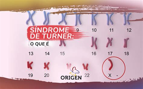 Sindrome De Turner Cromosoma