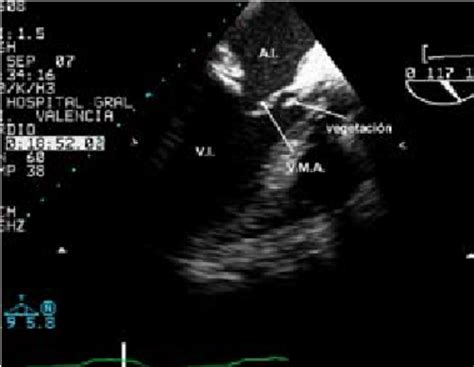 Ultrasound View Of Vegetation In Aortic Valve Vi Left Ventricle