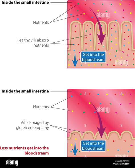 Absorption Of Nutrients In The Small Intestine Healthy And Damaged