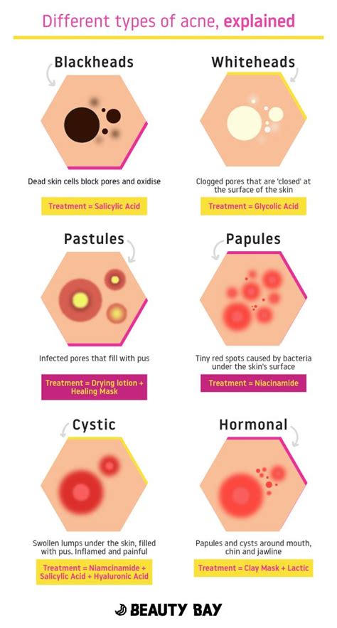 6 Different Types Of Acne Explained Beauty Bay Edited Skin Care