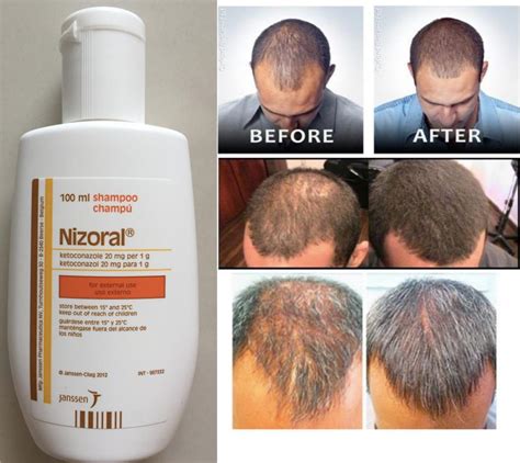 Ketoconazole Shampoo A Miraculous Anti Dandruff And Hair Loss Remedy
