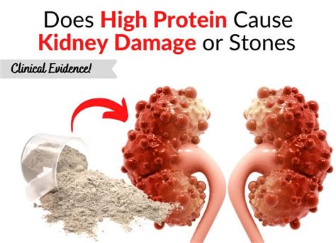 Can Kidney Stones Cause Long Term Damage