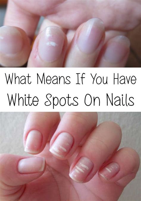 Incredible What Does White Marks On Nail Mean Ideas Inya Head