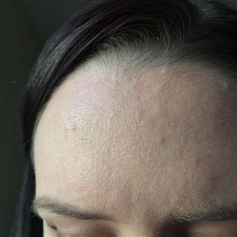 Skin Concerns Dry Flaky Forehead And Pimples That Sometimes Burn Or