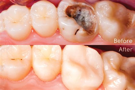 Conservative Dentistry Restoration Manik Dental Clinic