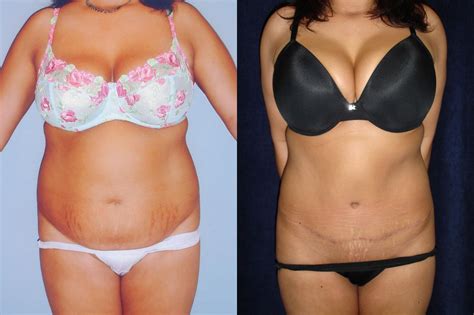 Tummy Tuck Before And After Photos Patient 67 San Francisco Ca