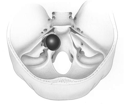 Anatomy Of Tumors In Skull Base Surgery And Neurotology Skull Base