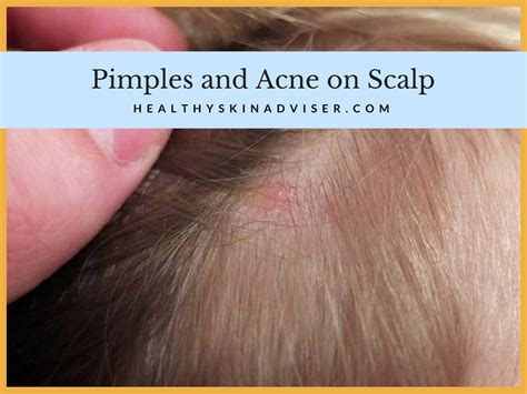 What Causes Pimples On Scalp Treatment For Acne On Scalp