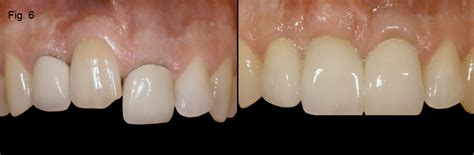 Ankylosis Part Ii Treating Adults With An Ankylosed Tooth Spear