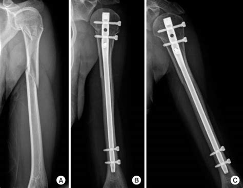 Intramedullary Nail On The Humeral Fracture