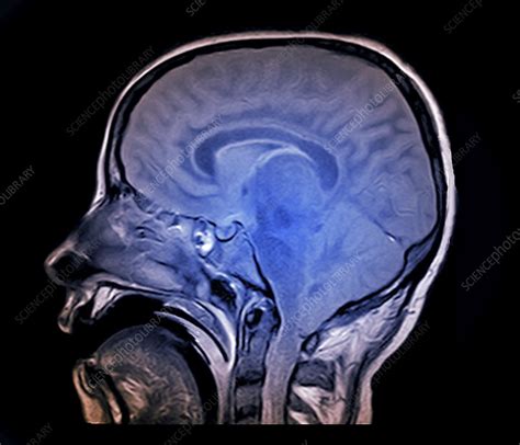 Brain Death Test Mri Scan Stock Image C0388668 Science Photo Library