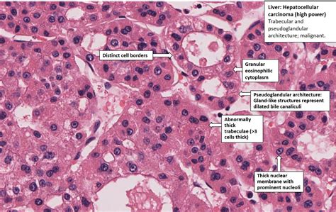 Liver Hepatocellular Carcinoma Nus Pathweb Nus Pathweb