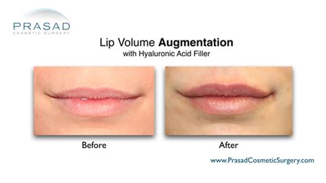 Lip Enhancement Before And After Photos Prasad Cosmetic Surgery