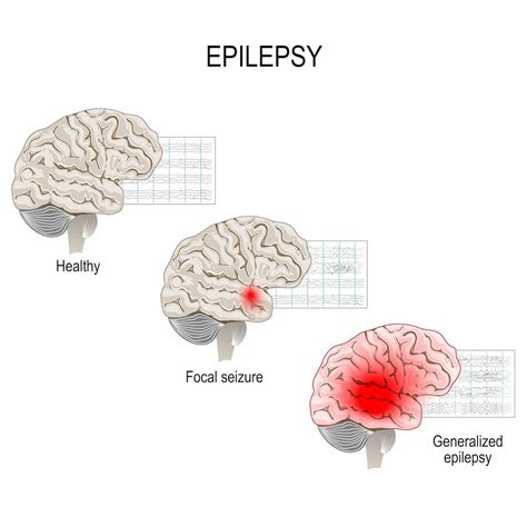 Epilepsy Causes Symptoms Treatments Live Science