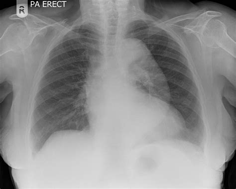 Aortic Aneurysm Apparent In A Simple Chest X Ray In A My Xxx Hot Girl