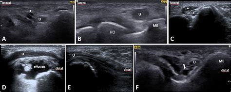 Frontiers Ulnar Neuropathy At The Elbow From Ultrasound Scanning To