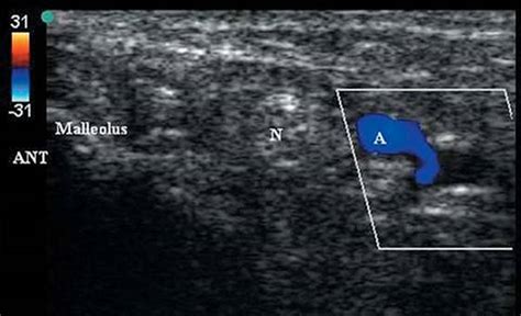 Ultrasound Guided Posterior Tibial Nerve Block Peripheral Nerve