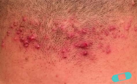 Bumps On Back Of Neck After Haircut Which Haircut Suits My Face