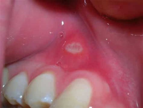 Blisters On Gums Above Tooth Oral Health