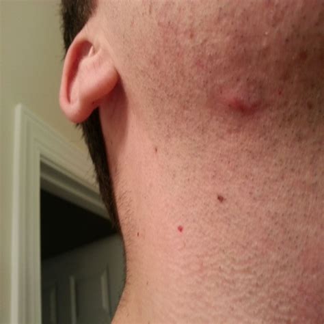 Itchy Bumps On Neck Pictures Photos