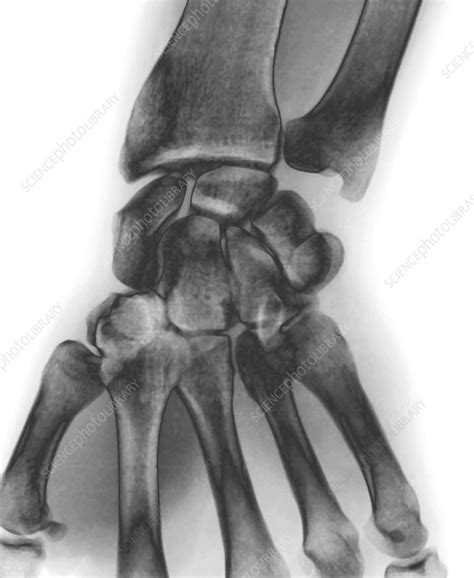 Normal Wrist X Ray Stock Image F0039169 Science Photo Library
