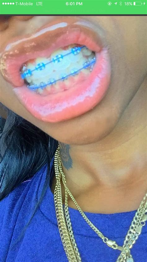 Pin By 𝘢𝘪𝘳𝘦𝘰𝘯𝘯𝘯♡ On Slayyyy In 2023 Cute Braces Braces Colors Cute Braces Colors