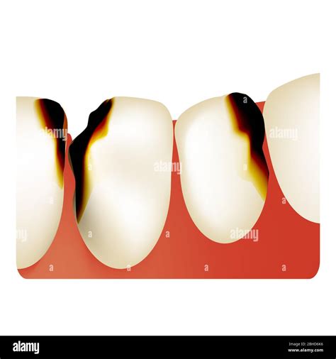 Dental Caries Tooth Decay Caries Infographics Vector Illustration On