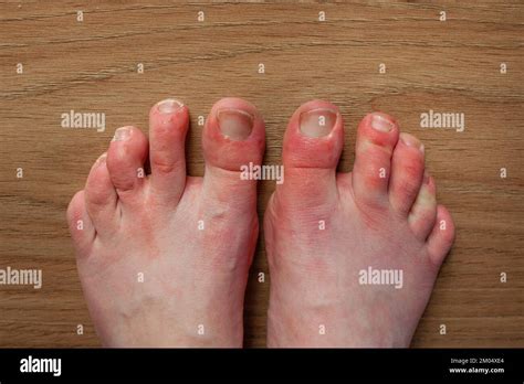 Feet Of Person With Raynauds Phenomenon And Chilblains Lesions On Toes