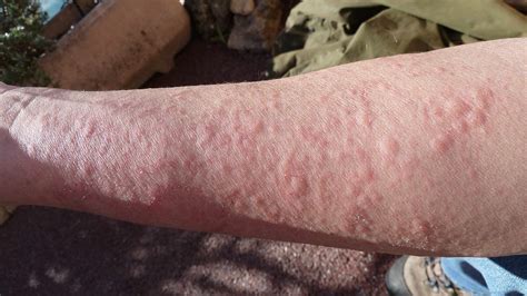 10 Serious Conditions That Rashes And Hives Can Indicate Page 3