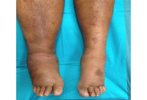 Type Diabetes Leg Swelling Sciencehub